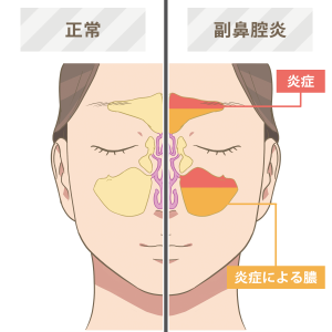 鼻の症状と疾患について 茨城県守谷市のほしの耳鼻咽喉科クリニック